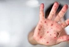 ماليزيا تسجل أول إصابة بجدري القرود خلال عام 2024