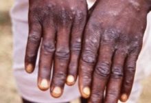 زيمبابوى تسجل أول حالتى إصابة بفيروس جدرى القردة